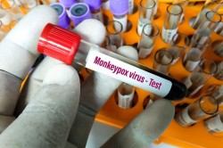 Al doilea caz de variola maimuței diagnosticat în România