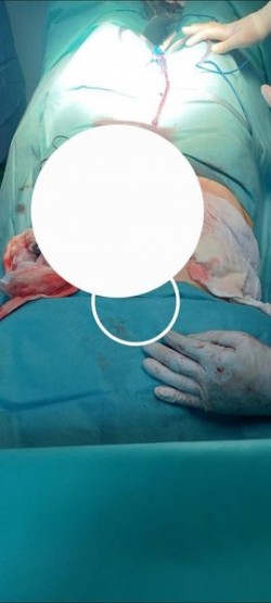 Tumoare uriașă de aproape 10 kilograme extirpată de medicii Spitalului Clinic Județean Arad

